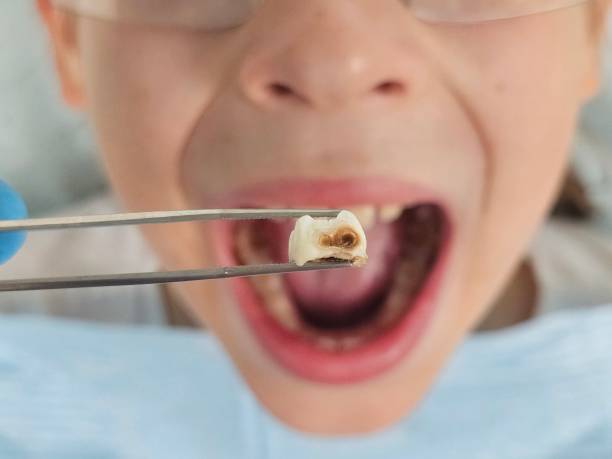 Best Emergency Treatment for Dental Infections or Abscesses in Mason City, IA